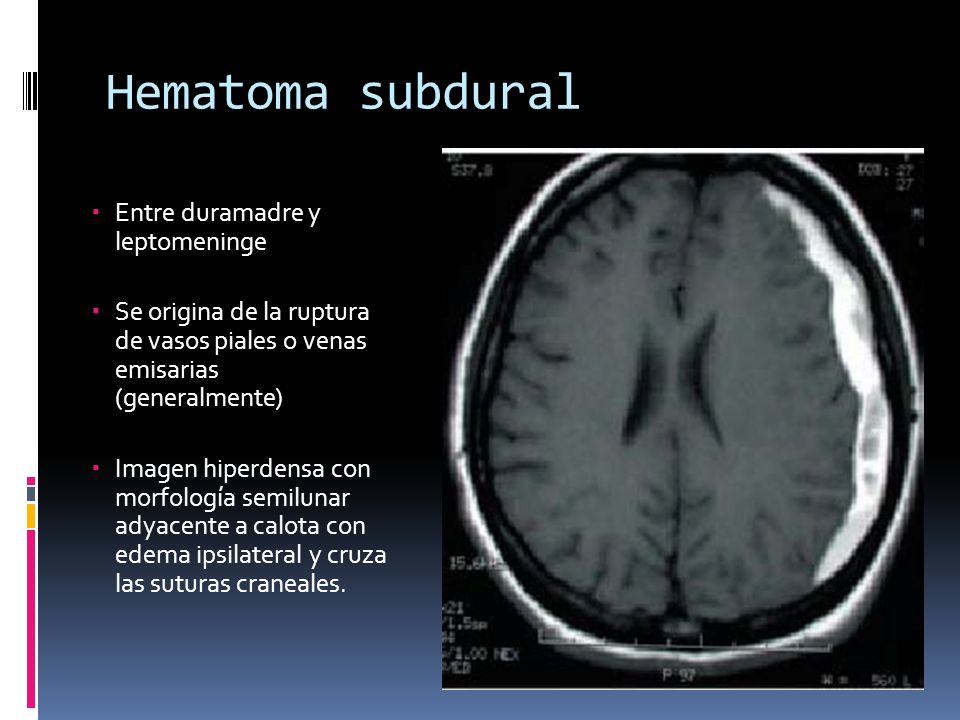 Hipertensión craneal calota Hipertensión craneal calota
